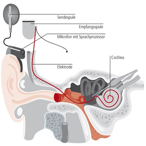 cochlea-implantat-1.jpeg