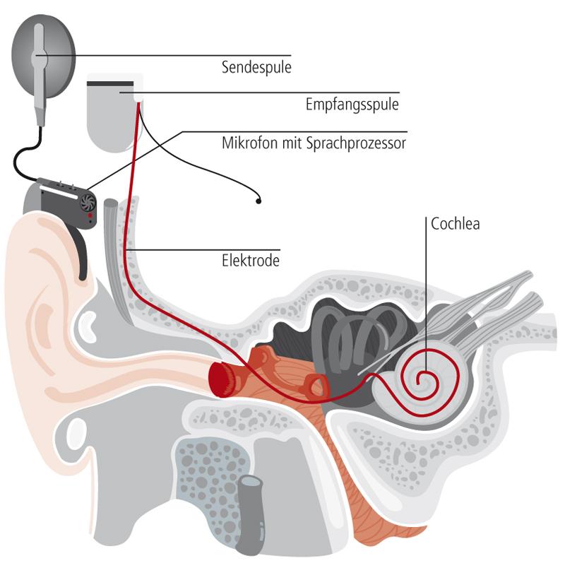 cochlea-implantat-1.jpeg