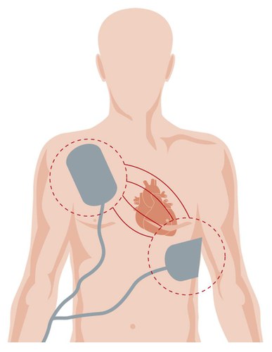 Position der Defibrillator-Elektroden während einer Defibrillation, Lage des Herzens, intrathorakaler Stromfluss während der Defibrillation